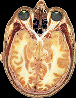 Visible human Visible human